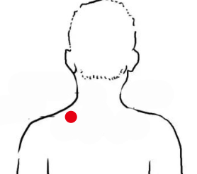 呼吸系统疾病（落枕）—取穴参考方案(图3)