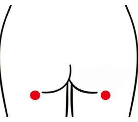 骨关节疾病（梨状肌综合症）—取穴参考方案(图3)