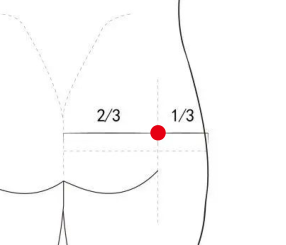 骨关节疾病（梨状肌综合症）—取穴参考方案(图1)
