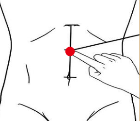 消化系统疾病（急性胃炎）—取穴参考方案(图2)