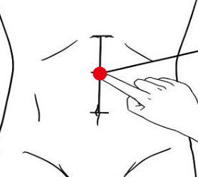 消化系统疾病（慢性胃炎）—取穴参考方案(图1)