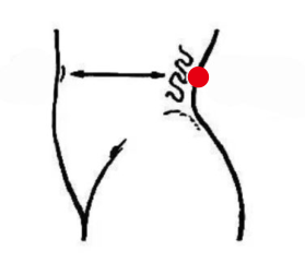 男科疾病（肾病综合症）—取穴参考方案(图2)