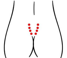 妇科疾病（子宫内膜异位症）—取穴参考方案(图3)