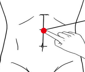 心脑血管疾病（高血糖）—取穴参考方案(图1)