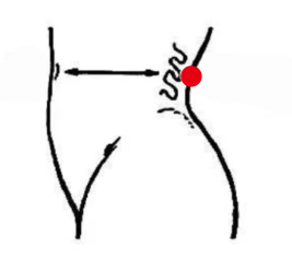 男科疾病（前列腺炎）—取穴参考方案(图3)