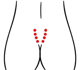 妇科疾病（子宫肌瘤）—取穴参考方案(图3)