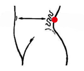 男科疾病（前列腺增生）—取穴参考方案(图2)