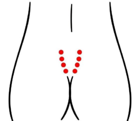 男科疾病（不孕不育）—取穴参考方案(图3)